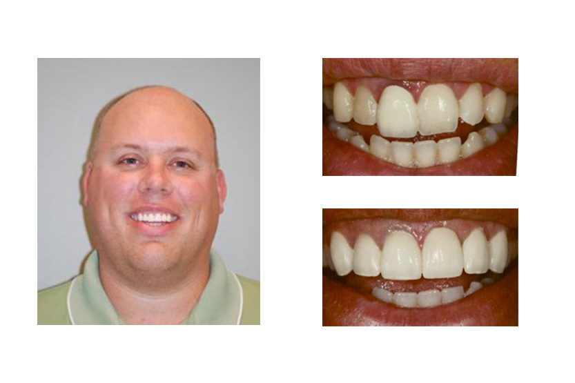 Dental Implants Dentist San Antonio