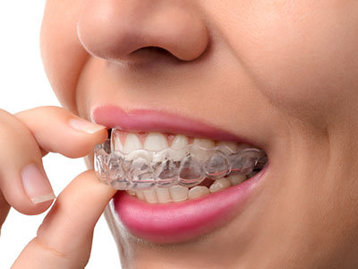 New Image Dentistry | Preventative Program, Ceramic Crowns and Digital Impressions