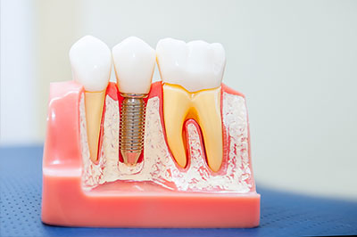 New Image Dentistry | Implant Dentistry, Oral Exams and Dentures