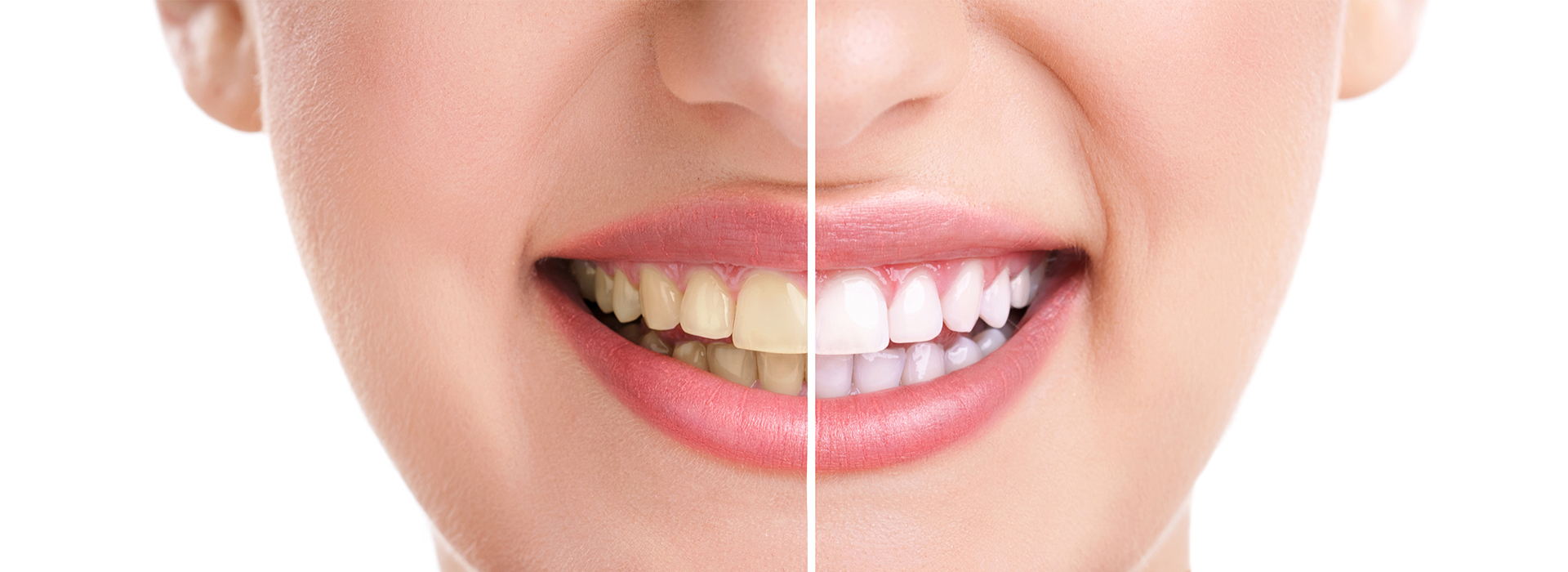 New Image Dentistry | Teeth Whitening, Intraoral Camera and Invisalign reg 